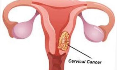 Gukingira kanseri y'inkondo y'umura mu bangavu bigabanya ibyago byo kuyirwara